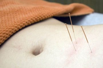 acupuncture, akupunktur, akapunktur, getat, iğneli zayıflama tedavisi