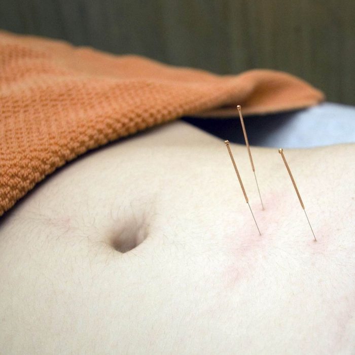 acupuncture, akupunktur, akapunktur, getat, iğneli zayıflama tedavisi