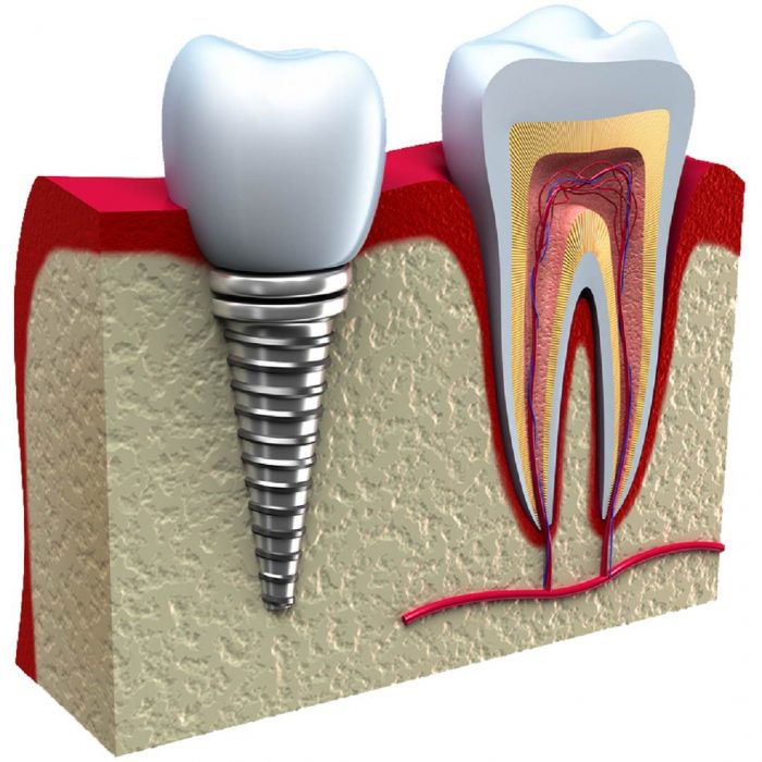 implant, ağız diş operayonu