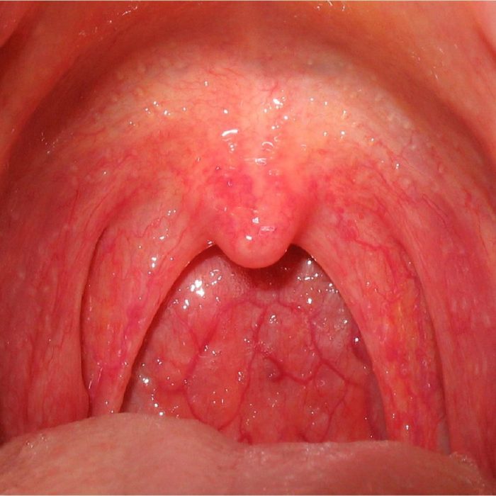 farenjit, Pharyngitis, ağız içi